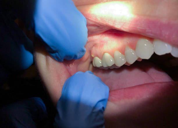 Best Emergency Wisdom Tooth Extraction in Vermillion, SD